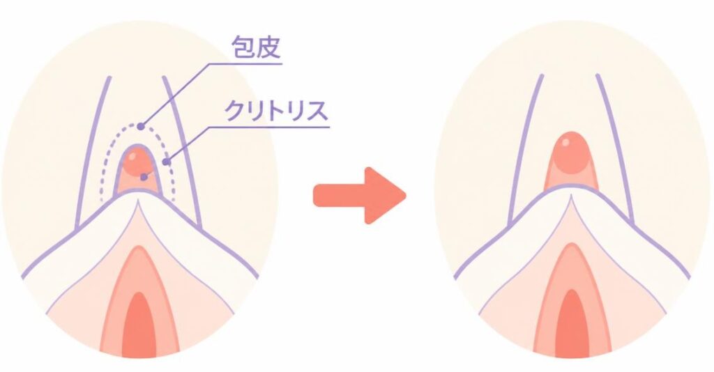 クリトリス包皮