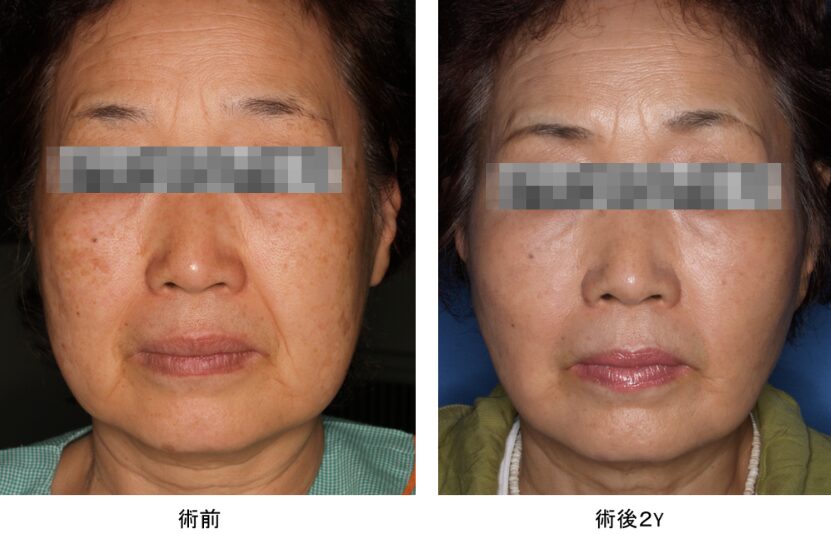 Jowl fat trnsfer法フェイスリフト　