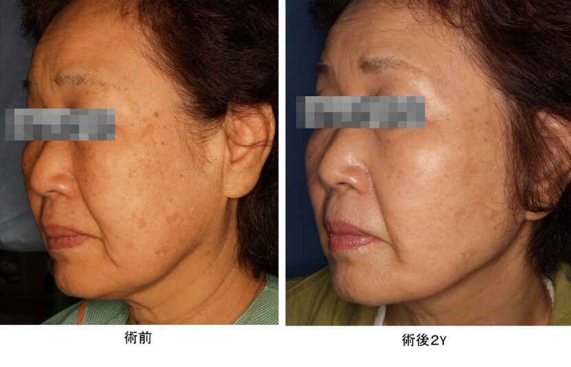 Jowl fat trnsfer法フェイスリフト　