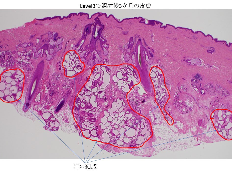 レベル3で治療されたワキの3か月後の皮膚
