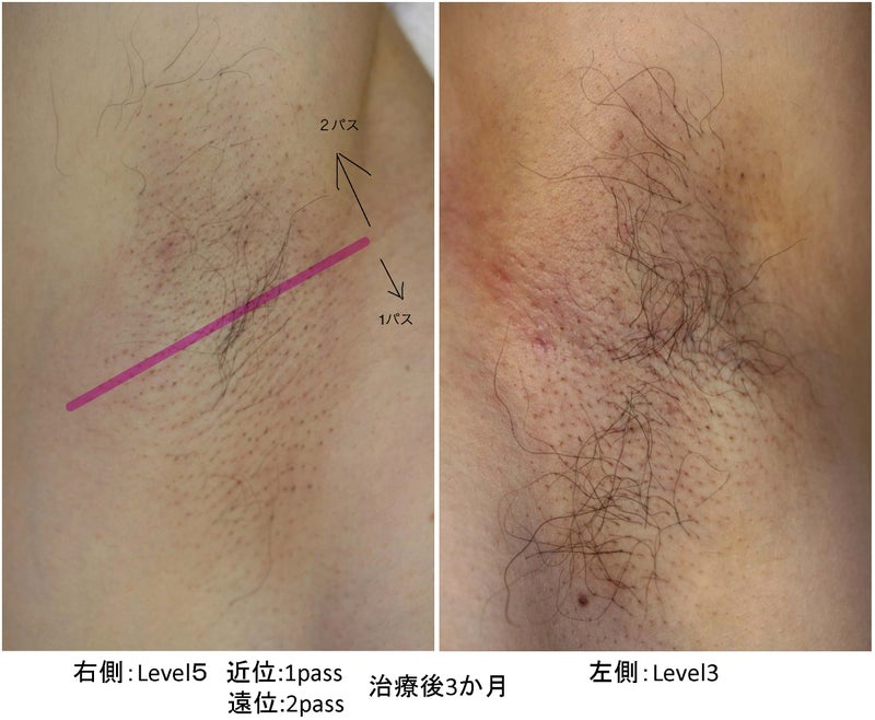 左脇はレベル３、右脇はレベル５で１パスと２パスです