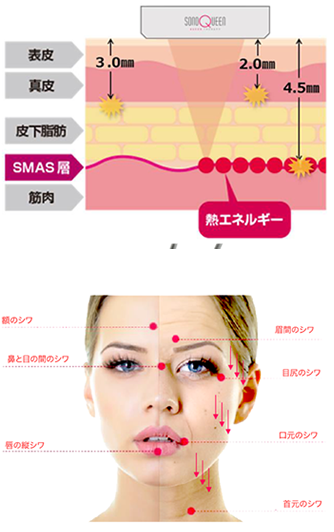 切らずにフェイスリフト級の効果