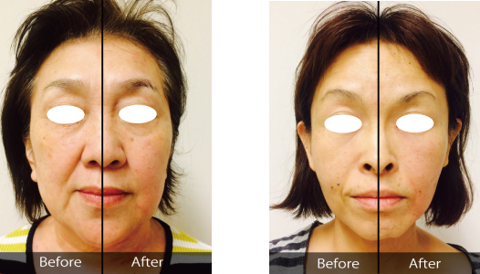 切らずにフェイスリフト級の効果